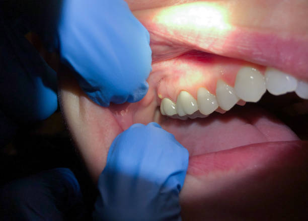 Tooth Infection Emergency Dentist in ND